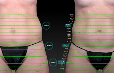 Kristen lost 842cc of fat at one UltraSlim treatment