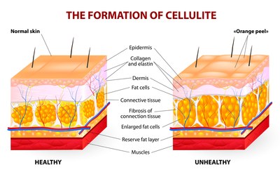 Cellulite occurs as the fat cells grow more than the connective bands<