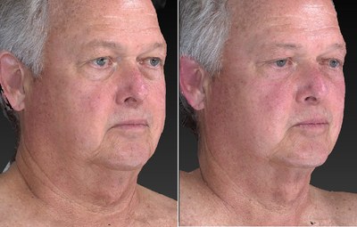 Before and after at one 20-minute bilateral UltraSlim treatment