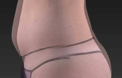 Kristen lost 1,336cc of fat in two weeks with 3 UltraSlim treatments