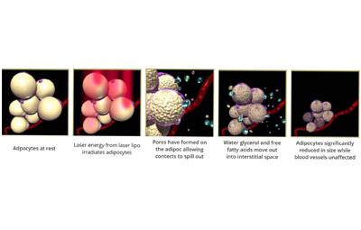 Mechanism of Action for UltraSlim by Robert H. Burke, MD, MS, DDS, FACS, FICS