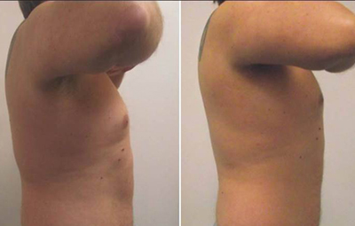 Before and after 6 UltraSlim treatments in Orlando, Florida