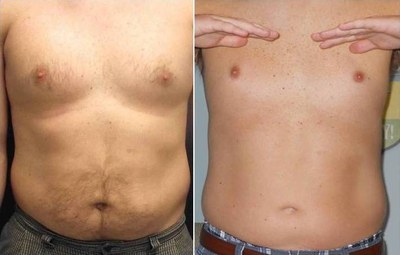 Before and after six UltraSlim treatments in Altamonte Springs, Florida