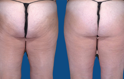 Hallee improved her cellulite, lost fat, and enjoys a 'lift' with UltraSmooth