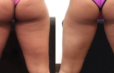 Personal trainer embarrassed by cellulite until UltraSmooth