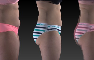 Zindy lost 28 pounds, 5432cc, and 4.4 inches off her waist with 8 UltraSlim treatments