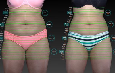 Zindy lost 28 pounds and 5432cc with 8 UltraSlim treatments