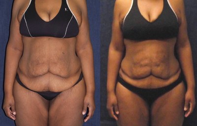 Before and after six UltraSlim treatments in Altamonte Springs, Florida