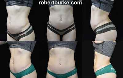 Fit patient 3 days after one UltraSlim Treatment</sup> treatment