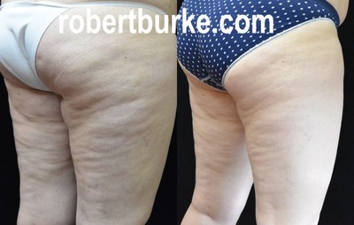 Banana Roll cellulite improved with 4 weekly UltraSlim treatments