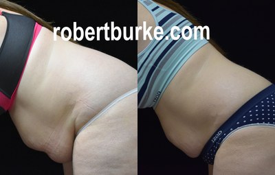 Before and after 6 weekly UltraSlim treatments