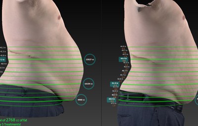 James lost 2.8 liters of stubborn belly fat in just four weekly UltraSlim treatments
