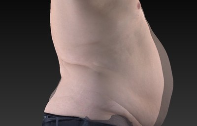 James lost 2.8 liters of stubborn belly fat in just four weekly UltraSlim treatments
