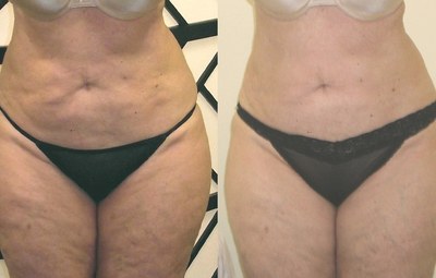 Dysmorphic fat from multiple liposuctions drained with 6 UltraSlim