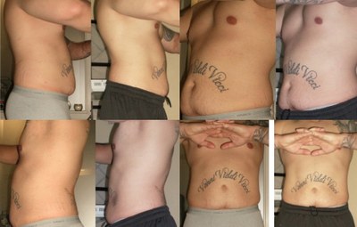 Before and after six UltraSlim treatments in Doctor Phillips, Florida