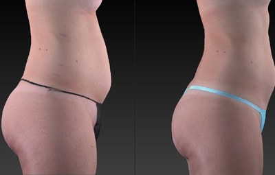 Kristen lost 1,336cc of fat in two weeks with 3 UltraSlim treatments